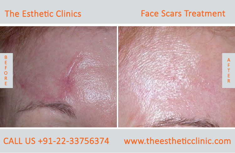 Face Scar Removal Laser Treatment before after photos in mumbai india (3)